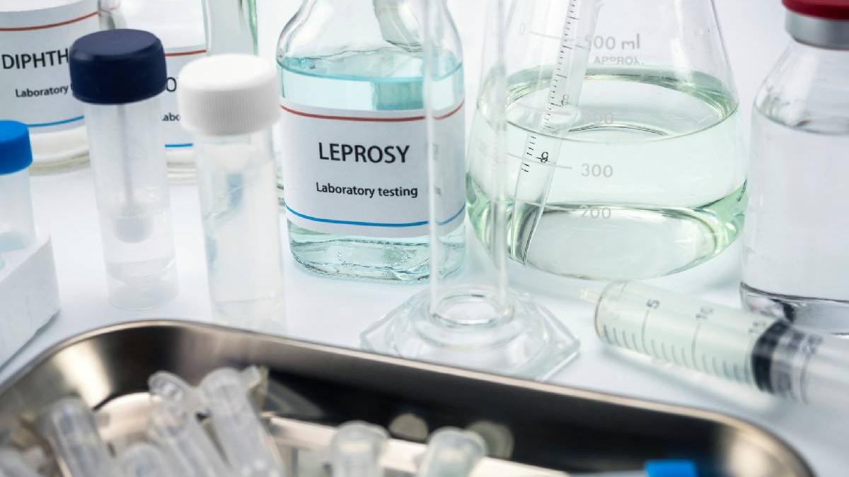 Al doilea caz de lepra confirmat in Cluj Napoca 1